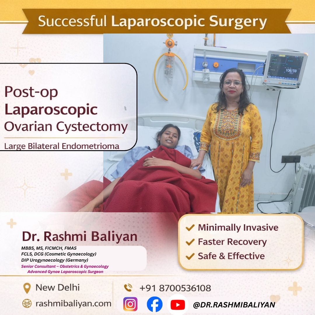 Laparoscopic Ovarian Cystectomy for Endometrioma